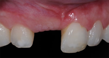 Prosthetics: Single crowns